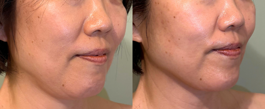 たるみケア1回のビフォーアフター