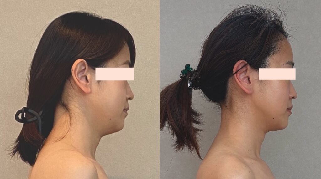 小顔集中コースのビフォーアフター写真