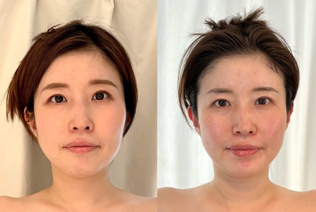 小顔集中コースのビフォーアフター写真