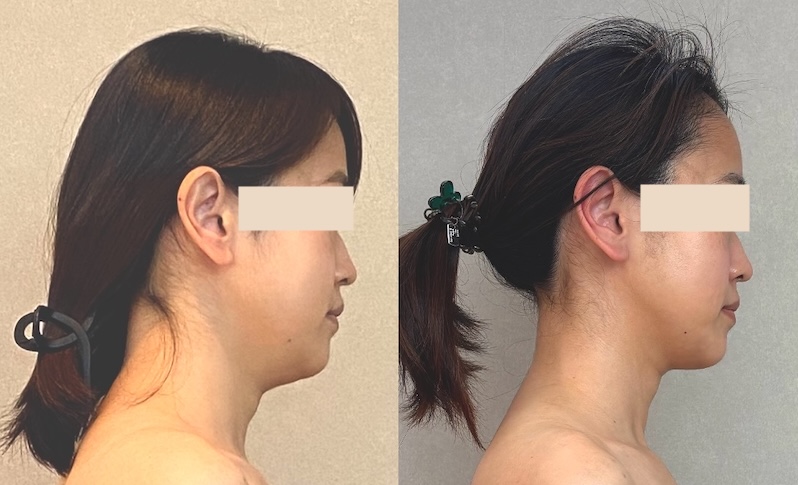 小顔集中コースのビフォーアフター写真
