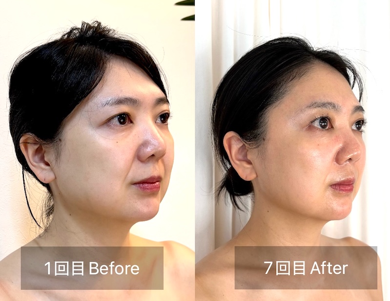 集中コースのビフォーアフター斜めの比較写真