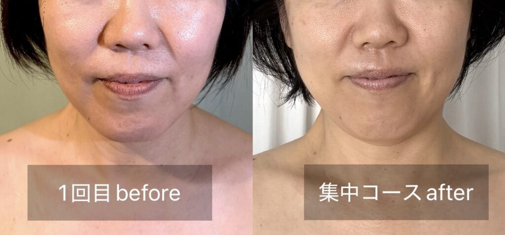 頬のたるみが引き上がったビフォーアフター