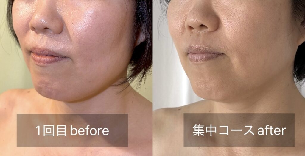 フェイスラインが引き上がったビフォーアフター