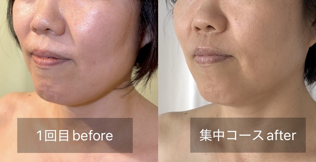 フェイスラインが引き上がったビフォーアフター