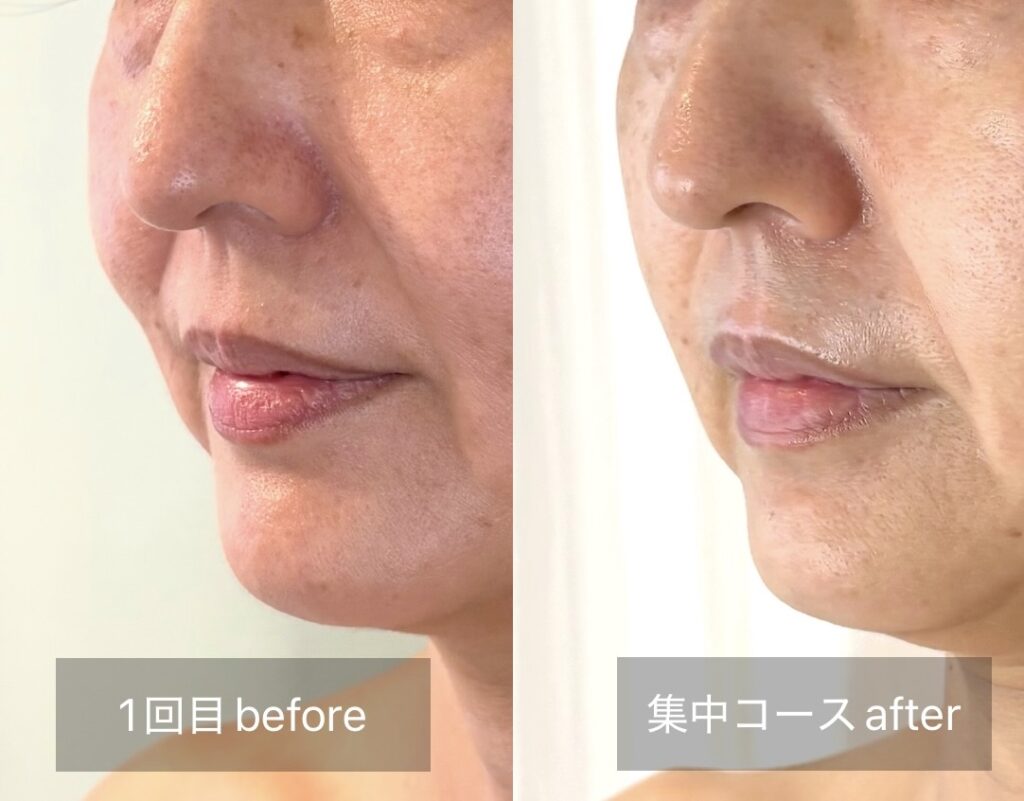 頬のたるみ改善のビフォーアフター