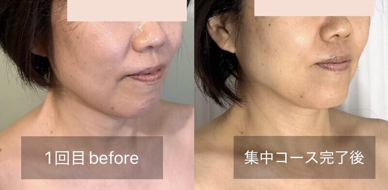 フェイスラインが引き上がったビフォーアフター