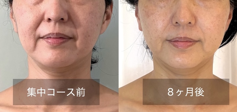 集中コースを終えてメンテナンスを継続しているお客様のビフォーアフター