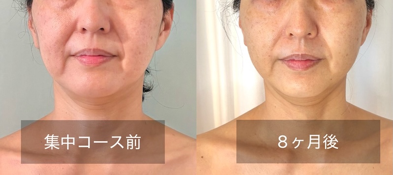 たるみケアを受け続けて8ヶ月後のお客様のビフォーアフター
