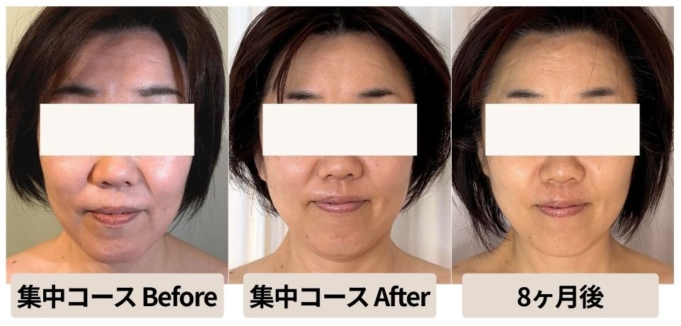 たるみケア集中コースから8ヶ月のお客様の変化