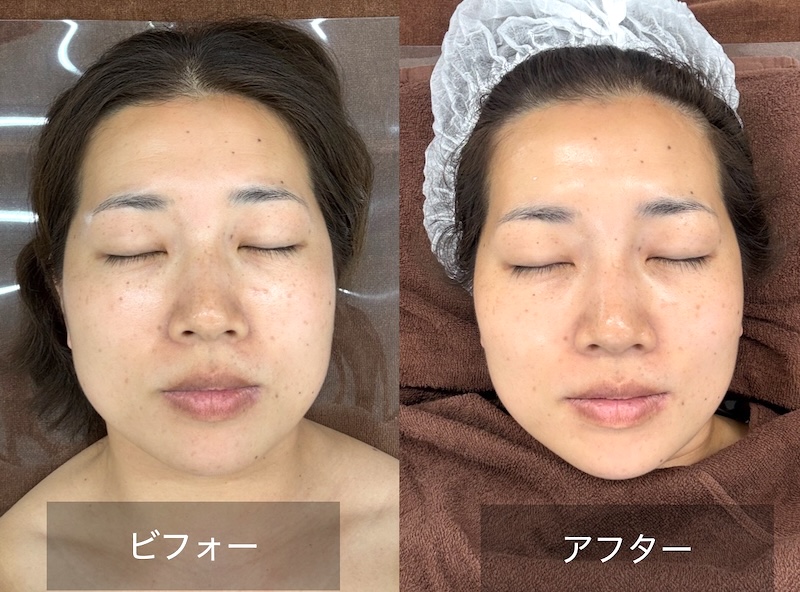 フェイシャル施術のビフォーアフター