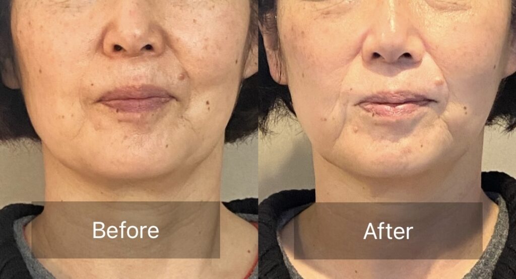 45分コース1回の変化の写真