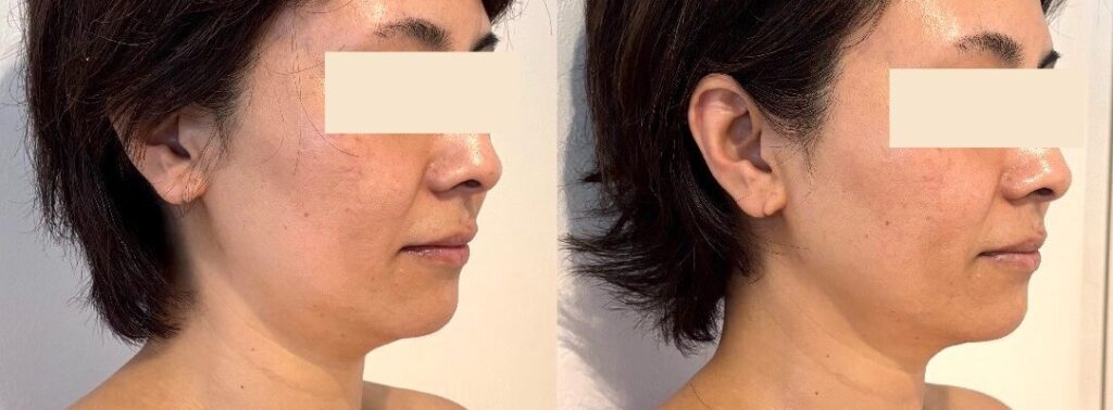 1回の施術であご下のたるみがスッキリしたビフォーアフター