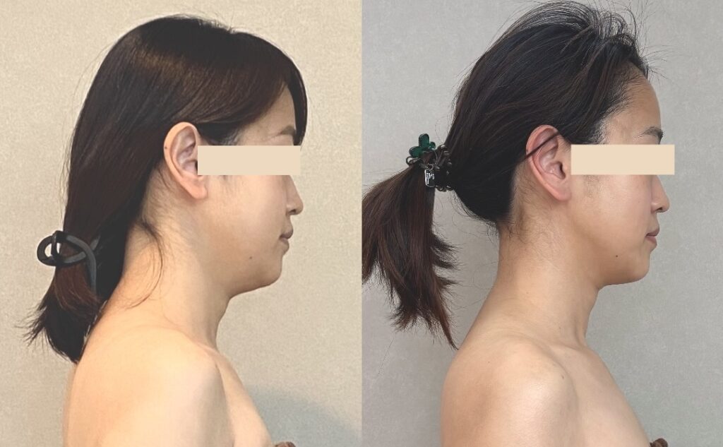 小顔集中プログラムのビフォーアフター写真