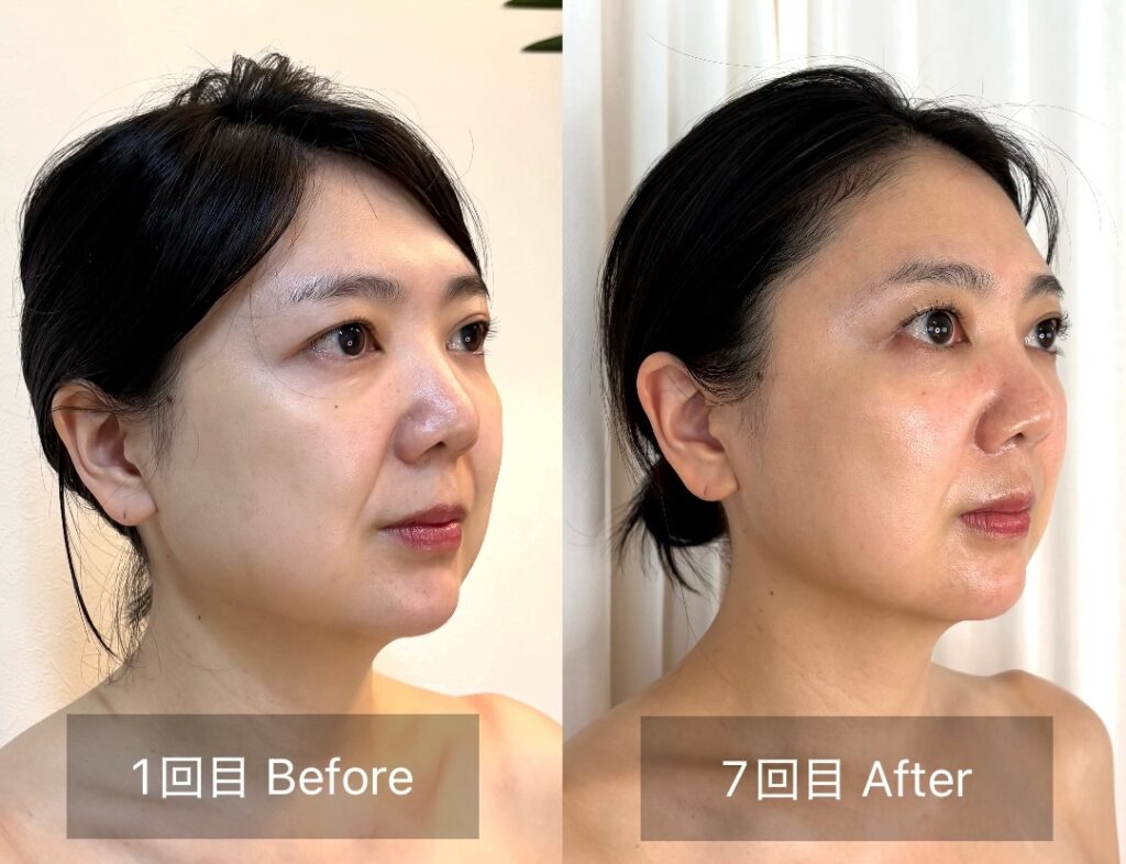 小顔集中プログラムのビフォーアフター写真