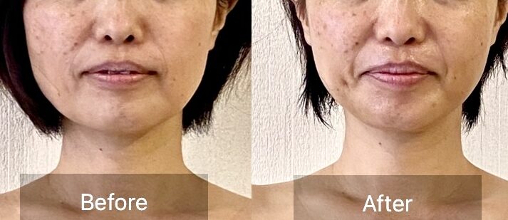 施術でたるみが引き上がった女性のビフォーアフター写真