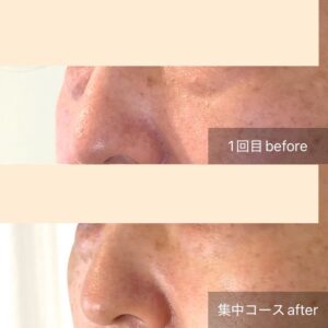 目の下のたるみのビフォーアフター