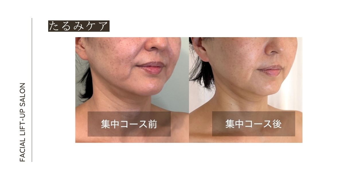 アイキャッチ「レチノールと施術でリフトアップしたビフォーアフター」