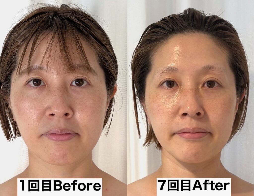 集中プログラムのお客様のビフォーアフター（正面の顔）