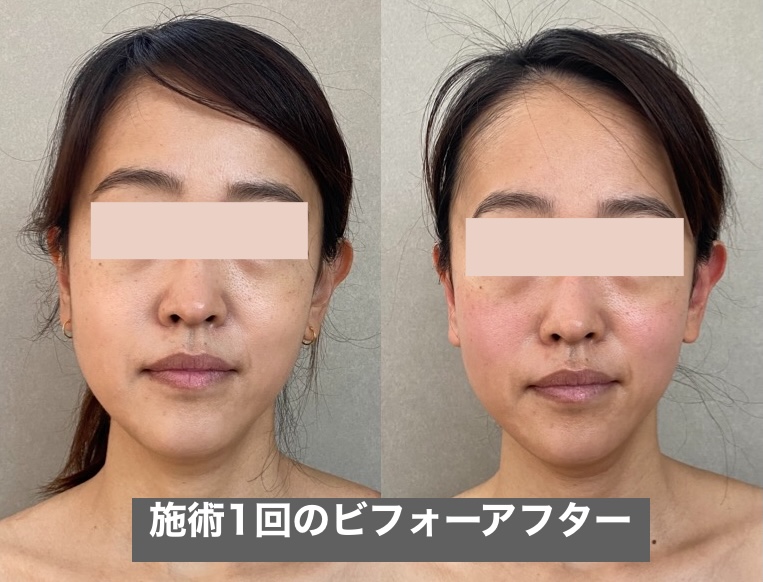 1回の施術でむくみがスッキリした様子